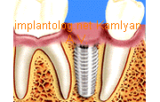  Имплантация зубов-зачем при небольших дефектах зубного ряда в Марьино 